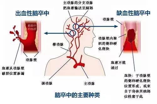 肺炎-呼吸訓練器-基層肺功能-腦卒中-心血管病-中風(fēng)-腦梗-慢阻肺-哮喘-呼吸肌-排痰-肺功能檢測儀-賽客